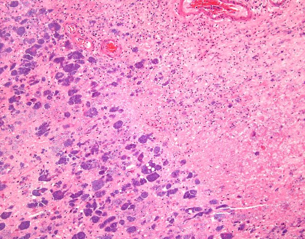 2B2 Histoplasmosis (Case 2) H&E 5