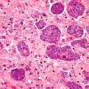 2B3 Histoplasmosis (Case 2) H&E 4A