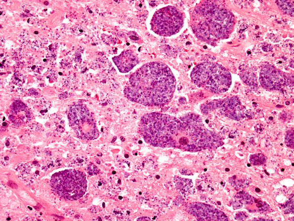 2B3 Histoplasmosis (Case 2) H&E 4A