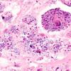 2B4 Histoplasmosis (Case 2) H&E 4