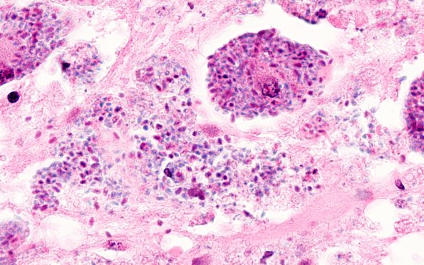 2B4 Histoplasmosis (Case 2) H&E 4