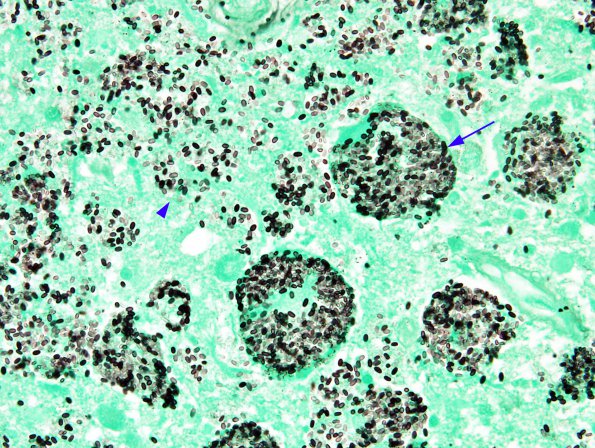 2C2 Histoplasmosis (Case 2) GMS 2 copy