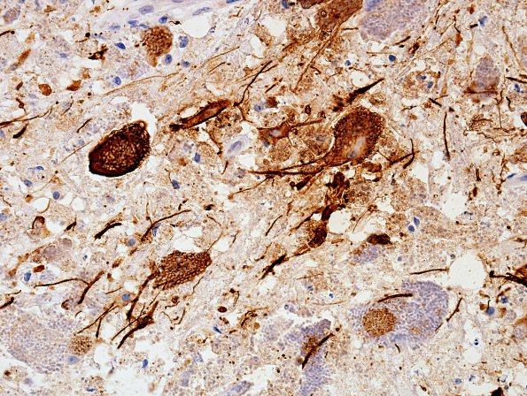 2C4 Histoplasmosis (Case 2) GFAP 2