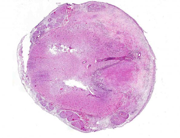 3A1 Histoplasmosis (AANP 2001 Case 5 H&E X whole mount