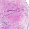 3A2 Histoplasmosis (AANP 2001 Case 5) H&E X2 1