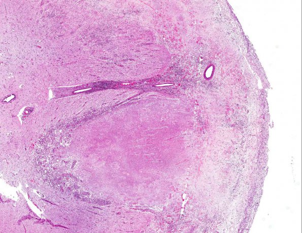 3A2 Histoplasmosis (AANP 2001 Case 5) H&E X2 1