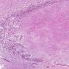 3A3 Histoplasmosis (AANP 2001 Case 5) H&E X4 3