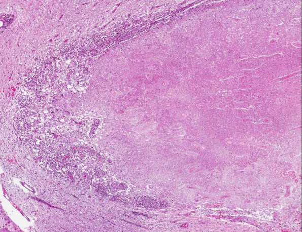 3A3 Histoplasmosis (AANP 2001 Case 5) H&E X4 3