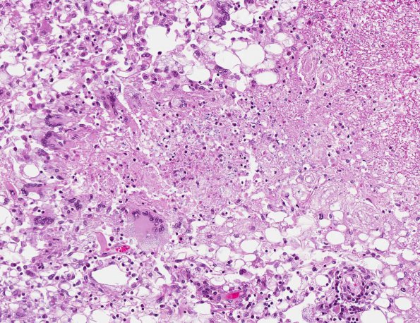 3A4 Histoplasmosis (AANP 2001 Case 5) H&E X20 1