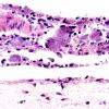 4 Histoplasmosis 3a meningitis (Case 3)