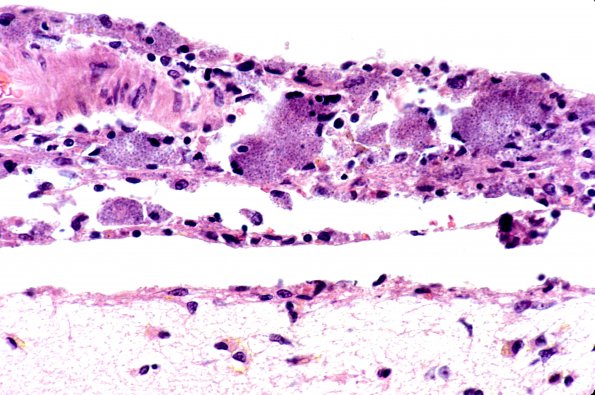 4 Histoplasmosis 3a meningitis (Case 3)