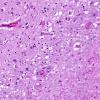 1A3 Microsporidiosis (AANP 1997, Case 6) H&E X20 5