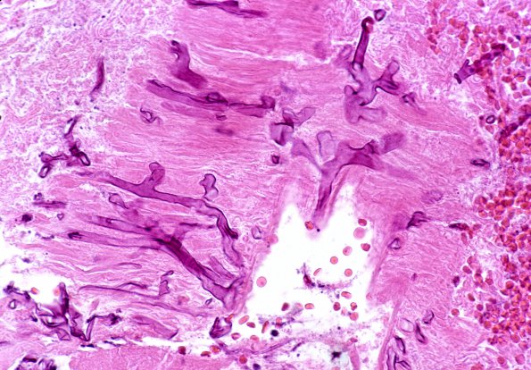 10 Mucormycosis 4 (Case 10)