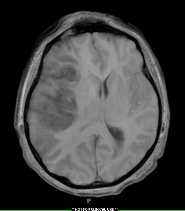 11A2 Mucormycosis (Case 11) T1 without contrast - Copy