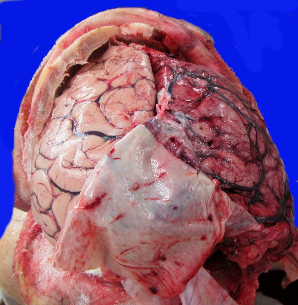 11B1 Mucormycosis Cavernous Sinus IC block (Case 11) _2