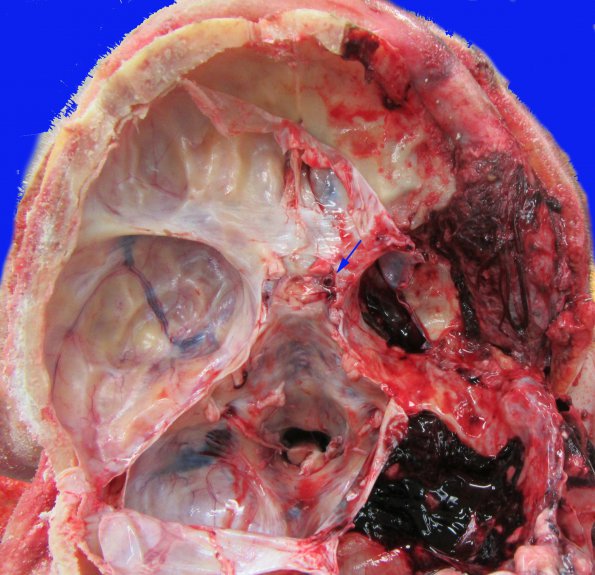 11B2 Mucormycosis Cavernous Sinus IC block (Case 11) _4 copy