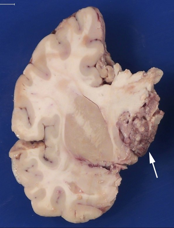 11B3 Mucormycosis Cavernous Sinus IC block (Case 11) _7 copy