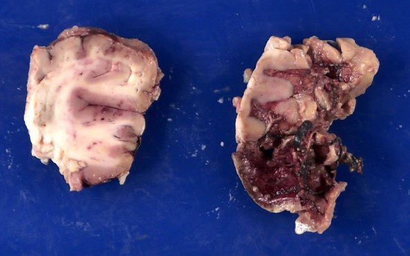 11B4 Mucormycosis Cavernous Sinus IC block (Case 11) _11