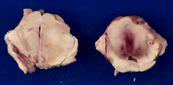 11B5 Mucormycosis Cavernous Sinus IC block (Case 11) _8