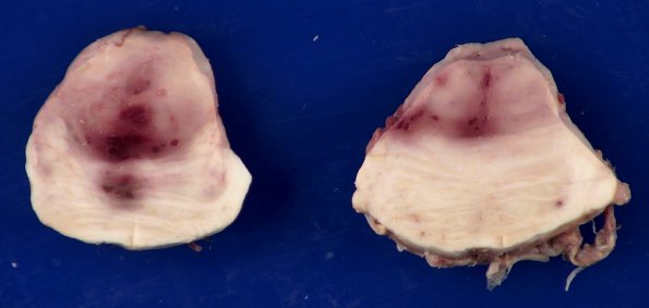 11B6 Mucormycosis Cavernous Sinus IC block (Case 11) _9