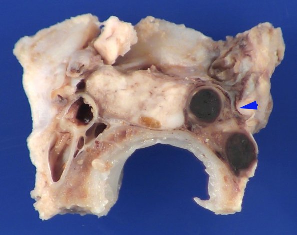 11B7 Mucormycosis Cavernous Sinus IC block (Case 11) _13 copy