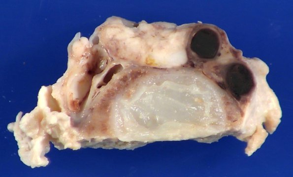 11B8 Mucormycosis Cavernous Sinus IC block (Case 11) _15