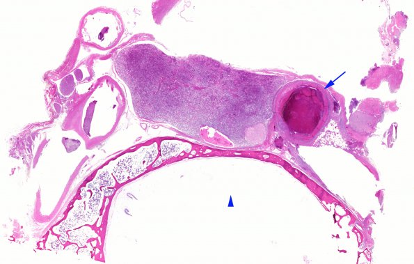 11C1 Mucormycosis Cavernous Sinus IC block (Case 11) N17 WM copy