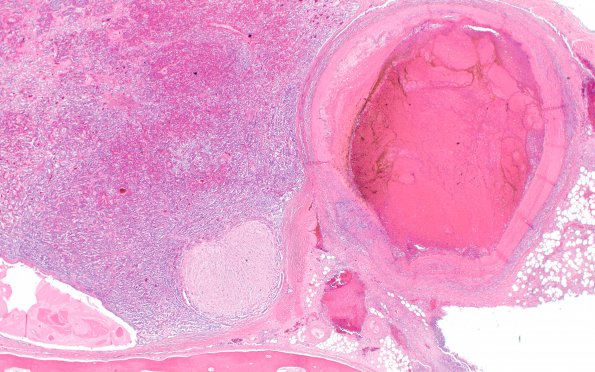 11C2 Mucormycosis Cavernous Sinus IC block (Case 11) N17 2X