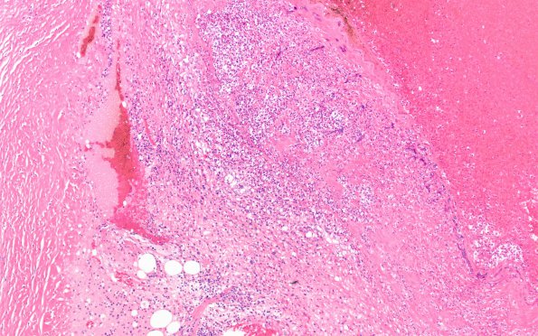 11C3 Mucormycosis Cavernous Sinus IC block (Case 11) N17 10X