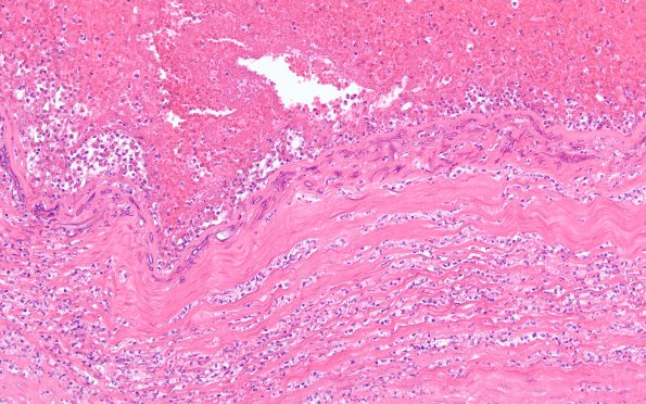 11C4 Mucormycosis Cavernous Sinus IC block (Case 11) N17 20X