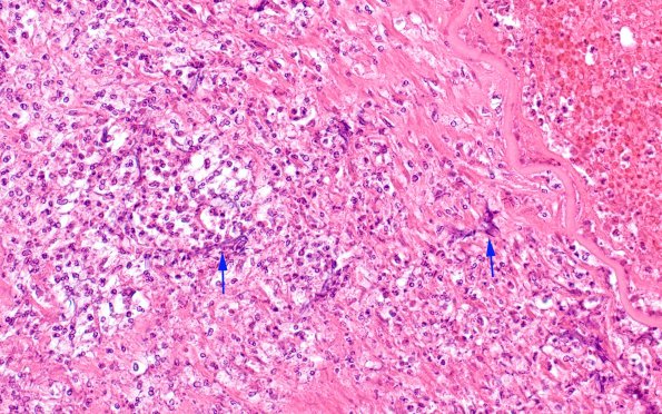 11C5 Mucormycosis Cavernous Sinus IC block (Case 11) N17 40X copy