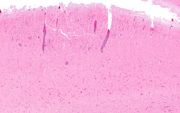 11C6 Mucormycosis Cavernous Sinus IC N13 (Case 11) H&E 2