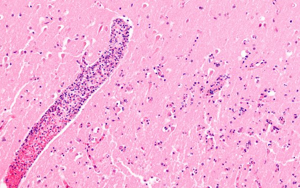 11C7 Mucormycosis Cavernous Sinus IC N13 (Case 11) H&E 1