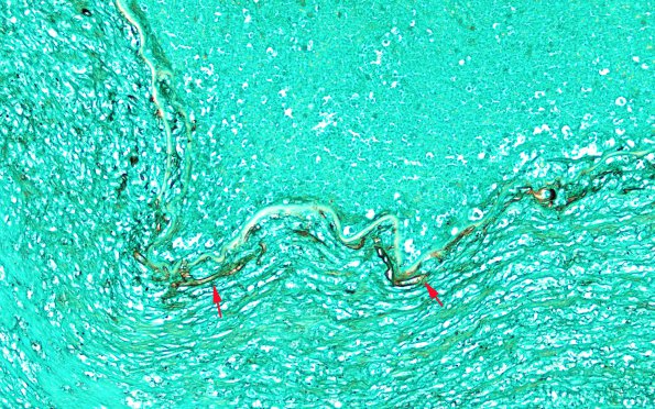 11D3 Mucormycosis, Cavernous Sinus, Right IC artery (Case 11) N17  GMS 10X 1 copy