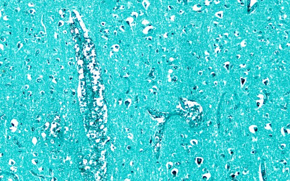 11D6 Mucormycosis, Cavernous Sinus Infarcted Brain no fungi (Case 11) N13  GMS 20X