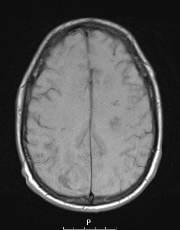 12A2 Abscess (Case 12) T1NoC A - Copy