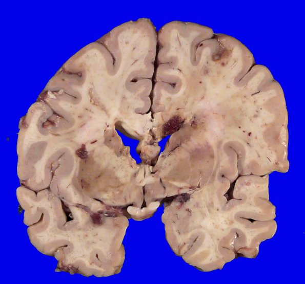 12B1 Abscess (Case 12) Gross_3