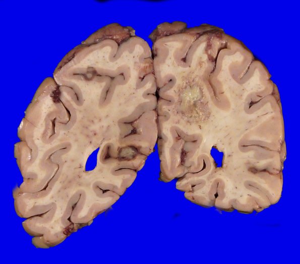 12B2 Abscess (Case 12) Gross_10