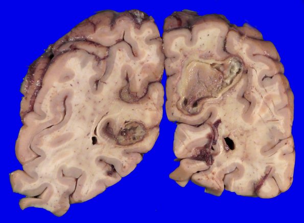 12B3 Abscess (Case 12) Gross_11