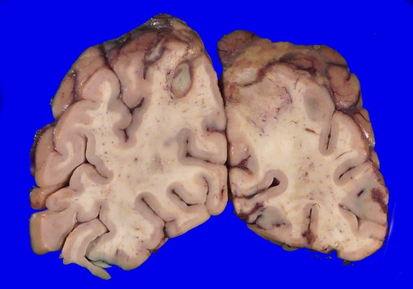 12B5 Abscess (Case 12) Gross_13