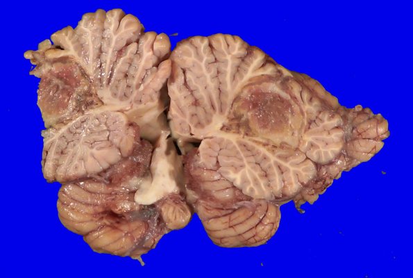 12B6 Abscess (Case 12) Gross_21