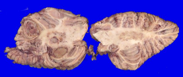 12B7 Abscess (Case 12) Gross_23