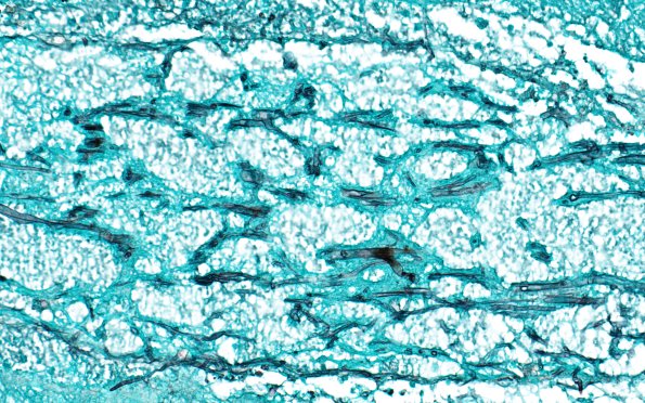 12D3 Abscess (Case 12) N4 GMS 40X
