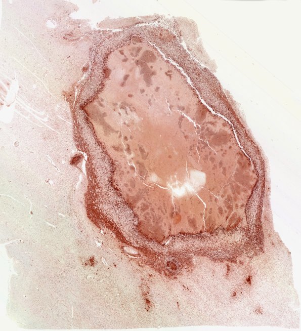 12F Abscess (Case 12) N4 CD68 WM