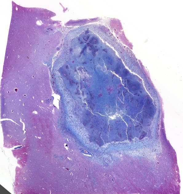 12H Abscess (Case 12) N4 TRI WM