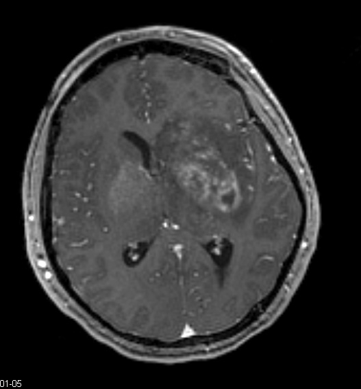 1A1 Mucor (Zygomycetes (Case 1) TRA 3D STEALTH W - Copy