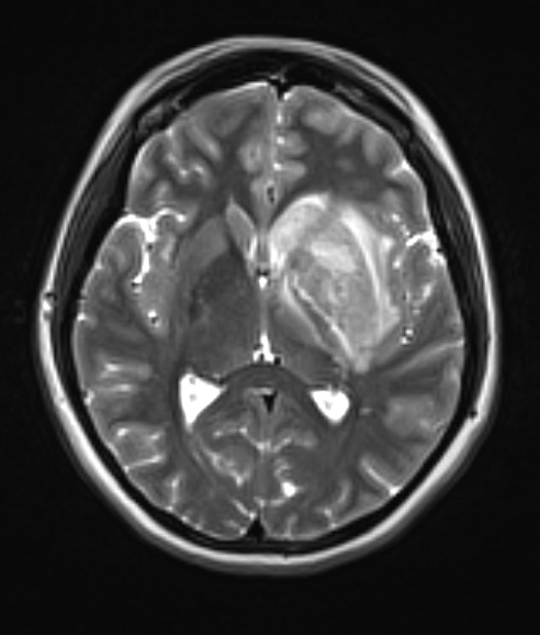 1A2 Mucor (Zygomycetes (Case 1) T2 - Copy