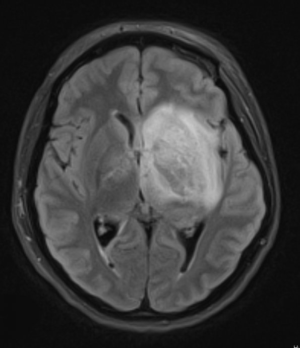 1A3 Mucor (Zygomycetes (Case 1) TIRM 1 - Copy