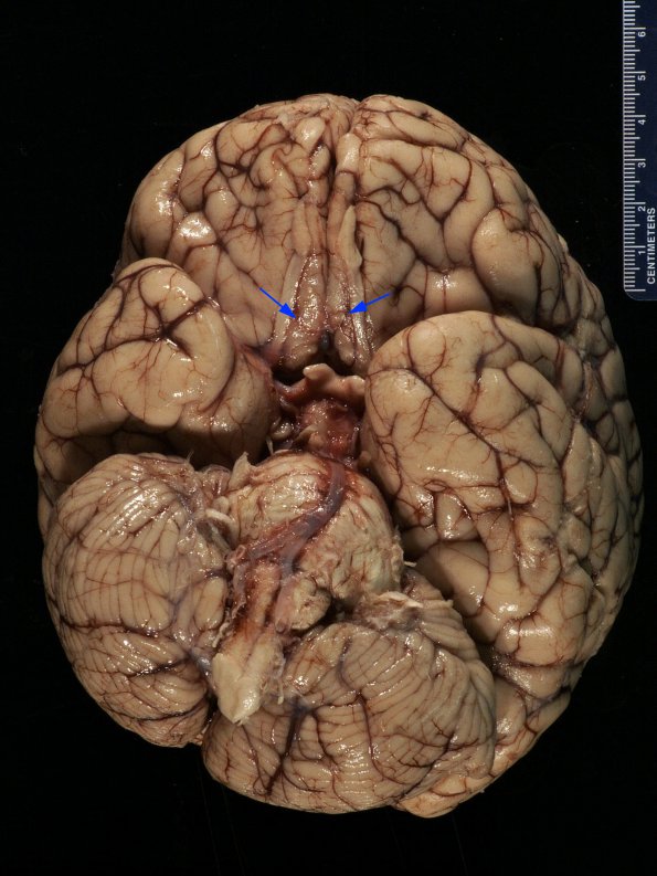 1B1 Mucor (Zygomycetes) (Case 1)_1 - Copy copy