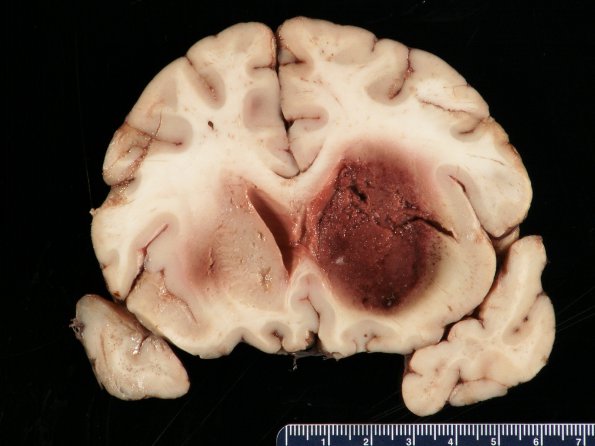 1B2 Mucor (Zygomycetes) (Case 1)_5 - Copy